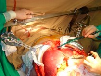 figura 1. Abordagem cirúrgica bastante invasiva.