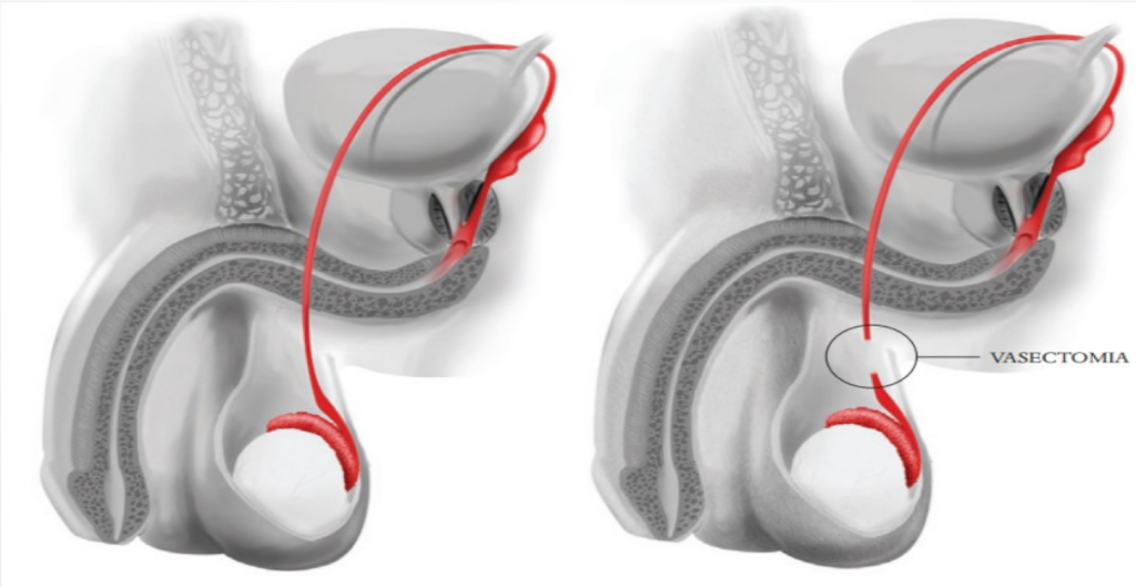 Vasectomia: O que é, Procedimento e Vantagens
