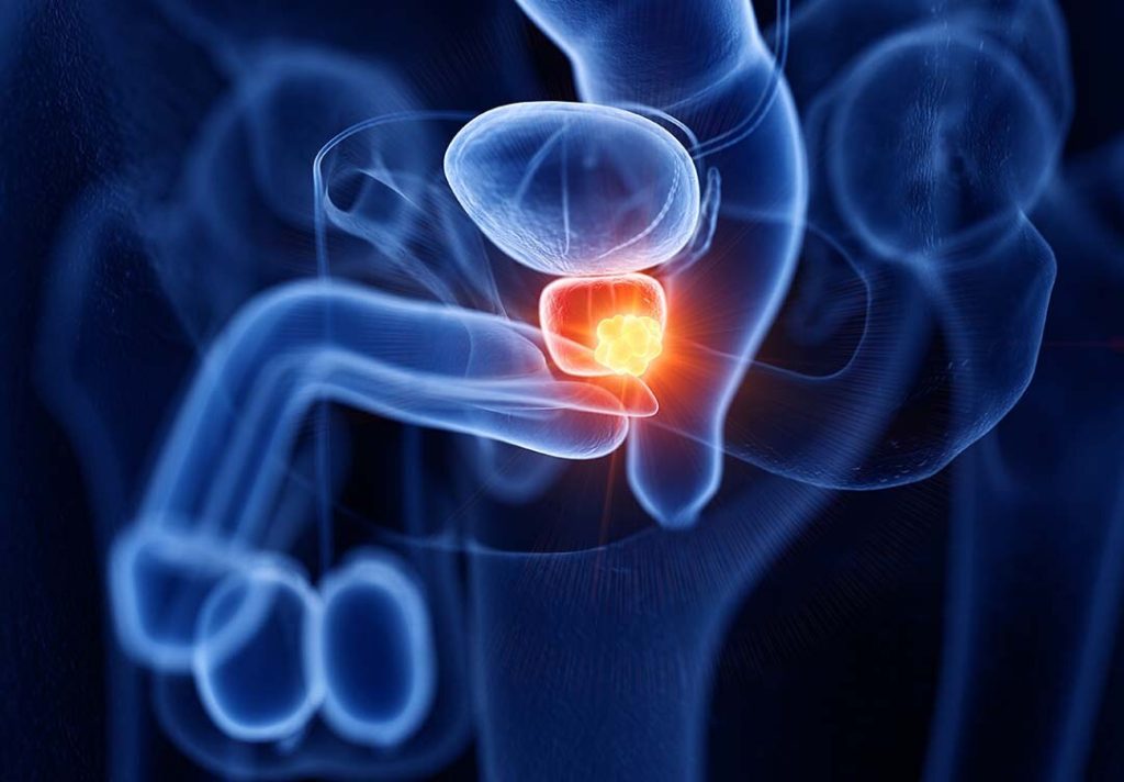 Novembro Azul e o câncer de próstata: A importância da prevenção