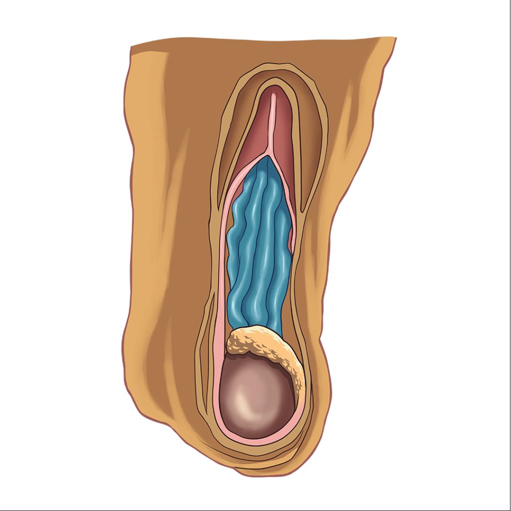 Varicocele: Uma Visão Abrangente sobre Causas e Soluções