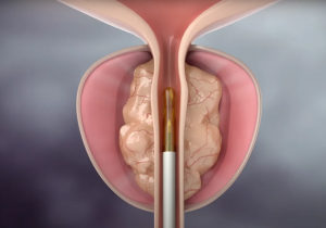 Rezum: alternativa menos invasiva para próstata aumentada